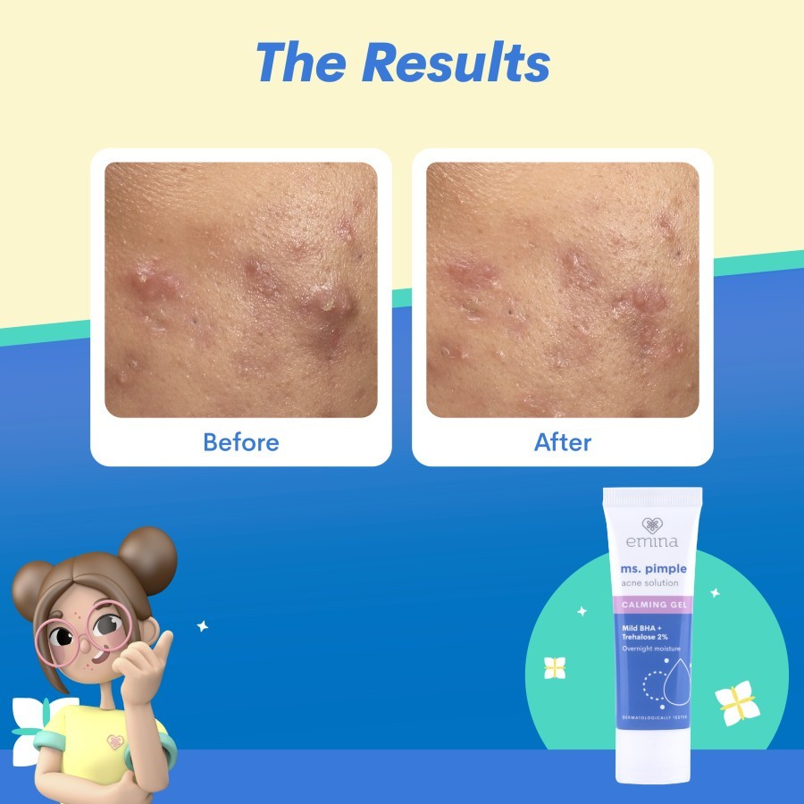 emina ms pimple acne solution calming gel 20 ml pelembab malam hari emina ms pimple acne solution calming gel 20 ml pelembab malam hari